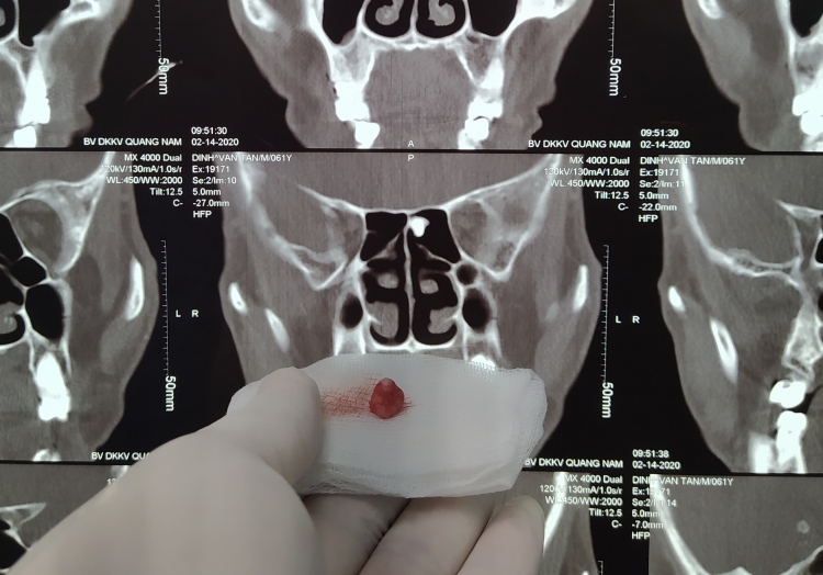 Quảng Nam: Phẫu thuật thành công một ca hy hữu răng mọc trong xoang và mũi