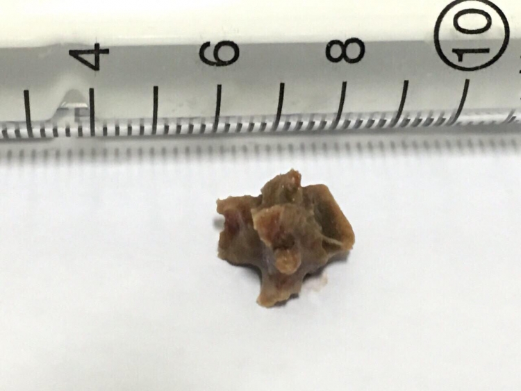 Lấy thành công xương cá “bỏ quên” trong phế quản bệnh nhân suốt 5 năm