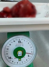 Phẫu thuật khối u nặng 4,5kg trong tử cung một người phụ nữ ở Quảng Nam