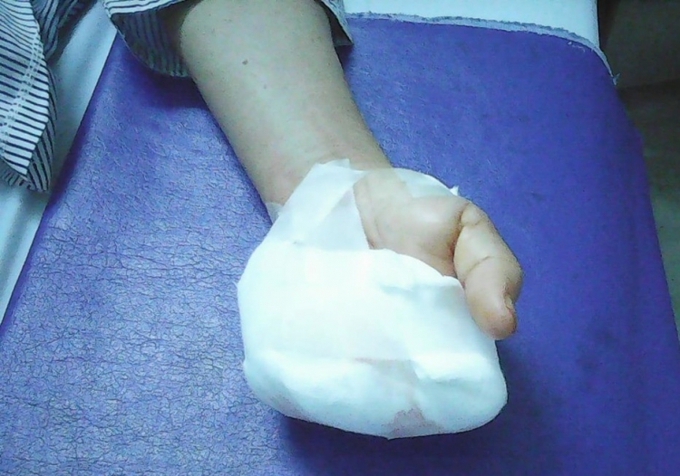 bat can trong khi xay thit mot phu nu o quang nam bi may nghien nat 4 ngon tay