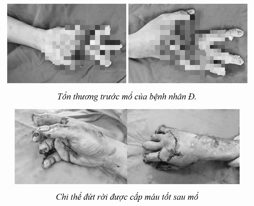 Hình ảnh bàn tay của bệnh nhân được các bác sĩ phẫu thuật nối lại thành công