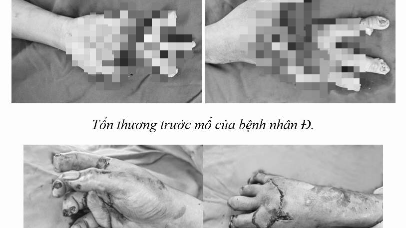 Bốn tiếng "cân não" nối 3 ngón tay đứt rời