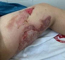 Quảng Ninh: Bé trai 12 tuổi bị bỏng nặng do nghịch cồn