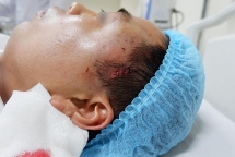 Người đàn ông phải cấp cứu  sau khi độn thái dương tại cơ sở thẩm mỹ không phép