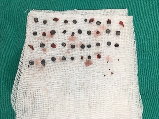 Gắp 39/50 viên đạn hoa cải 7 tháng găm trên mặt bệnh nhân