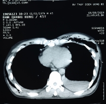 Cứu sống bệnh nhân gãy 15 xương sườn, tràn khí màng phổi