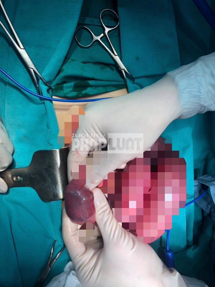 Đã mổ lấy dị vật gây tắc ruột của bệnh nhân "nghiện" trà sữa