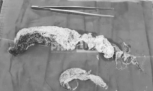 Quảng Ninh: Cháu bé 5 tuổi bị tắc ruột do tự ăn tóc của mình