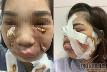 Nóng trong tuần: Hotgirl phải rạch mặt nặn mủ sau làm đẹp, trẻ suýt mất mạng vì thuốc hạ sốt