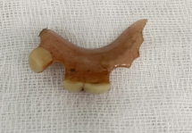 Quảng Nam: Răng giả rơi vào thực quản người phụ nữ