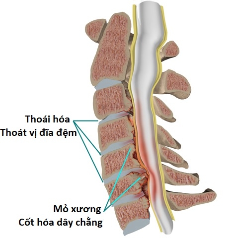 Bác sĩ mách bạn: Dấu hiệu của hẹp ống sống cổ với bệnh lý tủy cổ