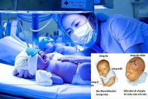 Trẻ 7 ngày tuổi phải thay máu vì vàng da nhân não