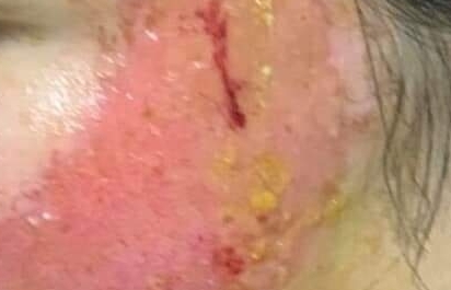 Tin lời cam kết đốt laser chữa rám má, người phụ nữ nhận cái kết đắng