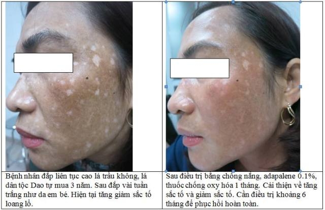 Bác sĩ mách bạn: Lạm dụng lá trầu không làm da loang lổ như bạch biến