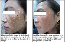 Bác sĩ mách bạn: Lạm dụng lá trầu không làm da loang lổ như bạch biến