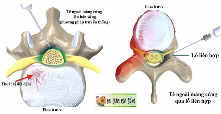 doc de biet dieu tri dau cot song khong can phau thuat