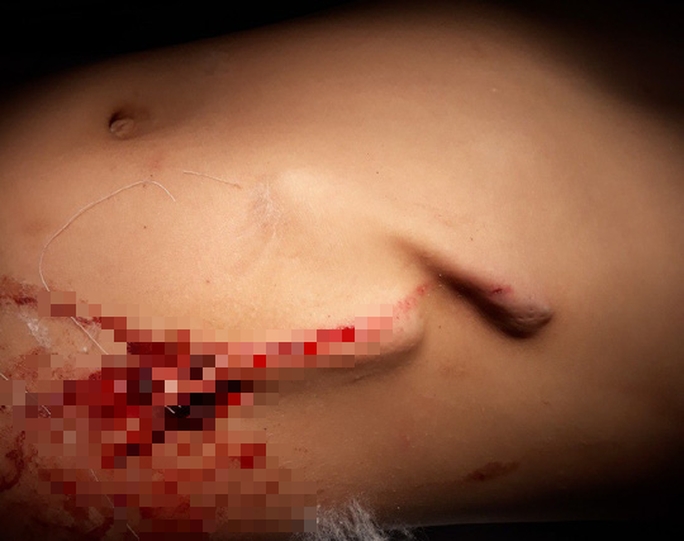 Bé trai 8 tuổi bị gốc cỏ voi đâm thủng bụng