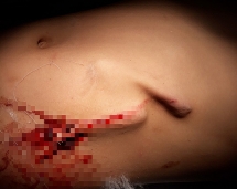 Bé trai 8 tuổi bị gốc cỏ voi đâm thủng bụng