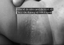 Bác sĩ mách bạn: Dự phòng và điều trị viêm da tã lót