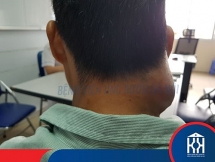 Khối u phát triển "tăng tốc" gây lệch mặt vì bệnh nhân tự đắp thuốc nam