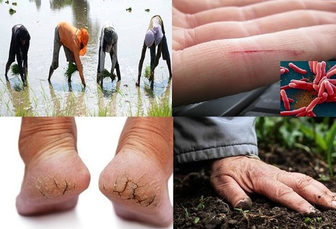 3 chị em ruột tử vong do bệnh Whitmore