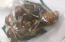 Phẫu thuật, lấy khối bã chứa hạt xoài trong dạ dày người đàn ông