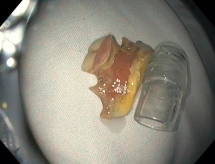 Một phụ nữ ở nuốt luôn hàm răng giả khi đang uống nghệ và mật ong