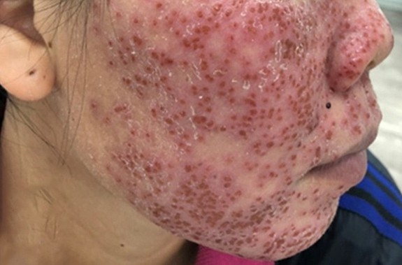 Bong tróc mặt do lột da bằng vi tảo biển