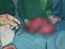 Chặn khối u 6 kg phát triển âm thầm trong một phụ nữ