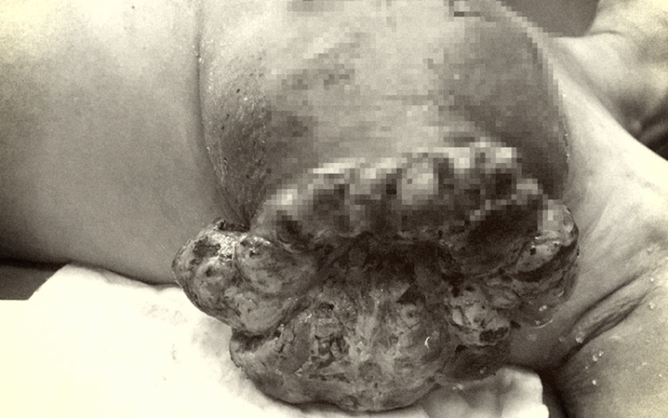 Khối u bị chảy máu lở loét, hôi thối do đắp thuốc nam