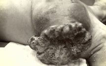 Khối u bị chảy máu lở loét, hôi thối do đắp thuốc nam