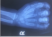 Bé gái bị đứt ngón tay do kẹt vào dây curoa máy rửa xe