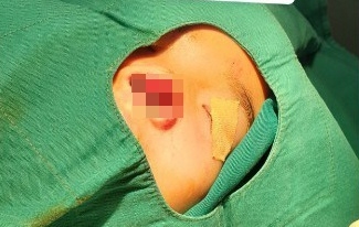 Tìm mảnh tổn thương mũi trong thùng rác để ghép cho bé 5 tuổi