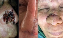 Cháu uống rượu say cắn mất mũi chú ruột