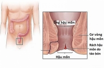 Bệnh nhân tự dùng vòi hoa sen xịt rửa do bị táo bón dẫn đến rách hậu môn