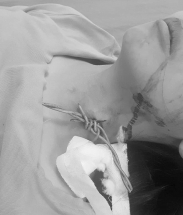 Ngã xe đạp điện cô gái bị hàng rào dây thép gai mắc vào cổ