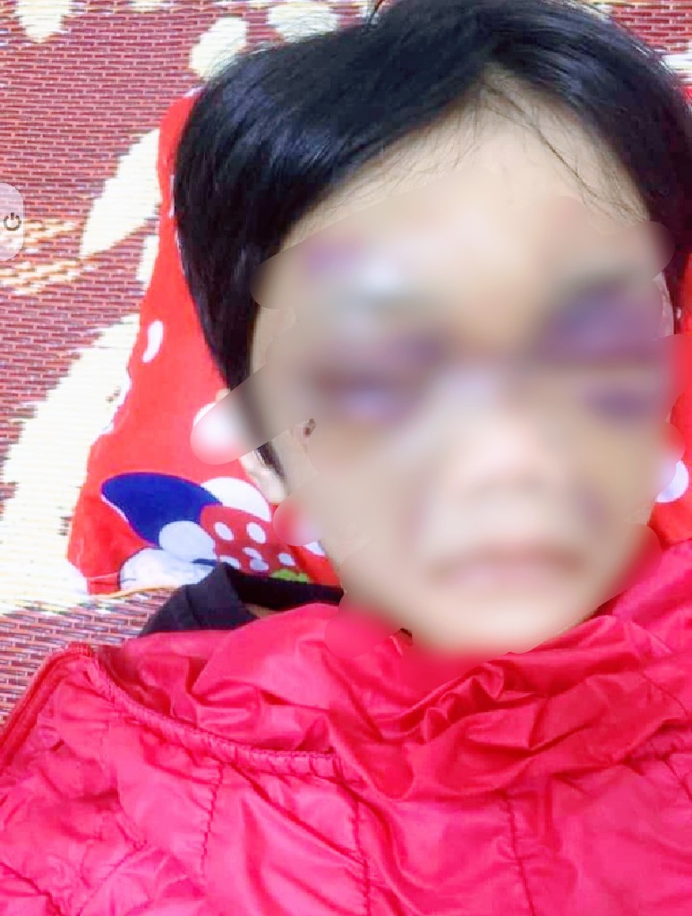 Hải Dương: Bé gái 6 tuổi bị mẹ đẻ bạo hành