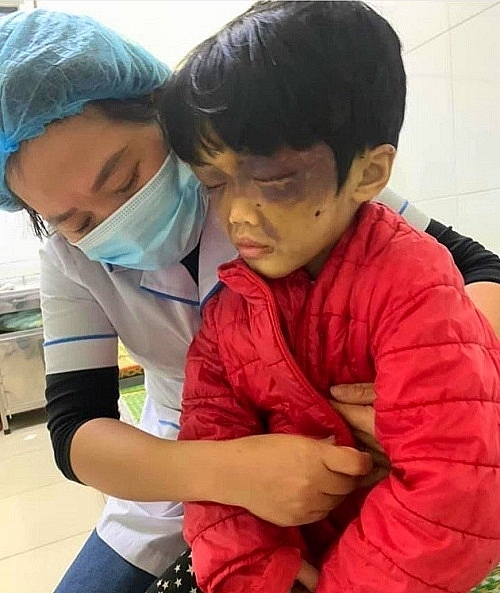 Cháu bé bị mẹ hành hạ dã man khi điều trị tại Bệnh viện Đa khoa tỉnh Hải Dương.