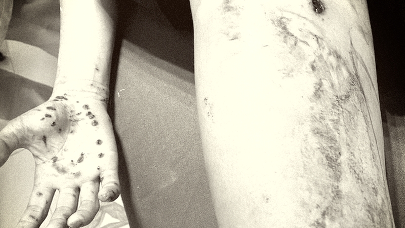 Hà Giang: Cắm dây sạc thì điện thoại phát nổ gây tổn thương nghiêm trọng ở tay và đùi