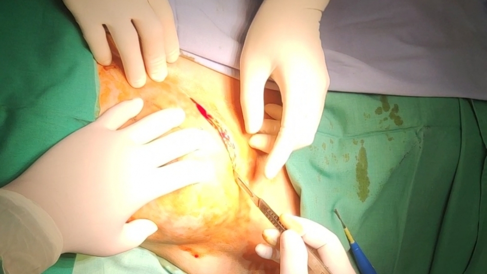 Vĩnh Phúc: Phẫu thuật thành công cho bệnh nhân bị ung thư vú