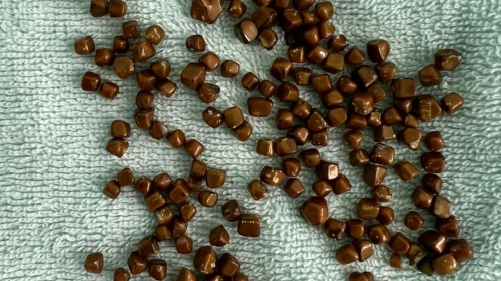 Vĩnh Phúc: Một bệnh nhân 77 tuổi có 175 viên sỏi trong túi mật