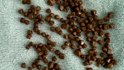 Vĩnh Phúc: Một bệnh nhân 77 tuổi có 175 viên sỏi trong túi mật