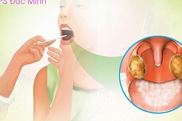 Vĩnh Phúc: Tăng cường công tác phòng, chống bệnh bạch hầu