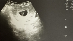 song lo vinh phuc mo thanh cong ca song thai rat hiem gap