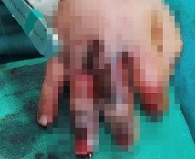 Hiểm họa từ máy ép nước mía: Thêm 1 bé 4 tuổi dập nát bàn tay