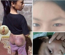 Công an viên đánh tím người cháu bé thiểu năng vì nghi trộm tiền
