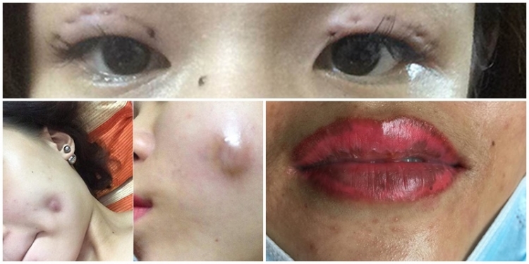 Hậu quả “ghê rợn” của việc phun xăm môi