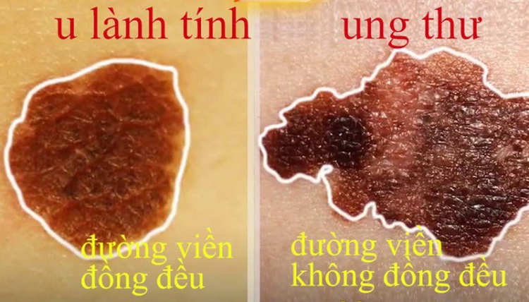 Nốt ruồi có thể giúp ta nhận biết về ung thư