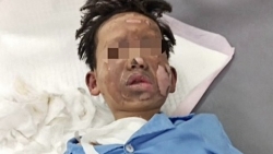 Bắc Giang: Bé trai 8 tuổi bị bỏng nặng vùng mặt khi sử dụng laptop phát nổ