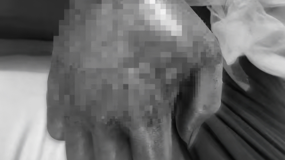 Bắc Giang: Hoại tử tay sau 3 ngày chữa rắn hổ mang cắn bằng thuốc nam